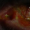 Left Eye - 24 year old male who suffered Toxic Epidermal Necrolysis Syndrome with severe Ocular involvement. Photo was taken 2 years after the initial TEN reaction (2)